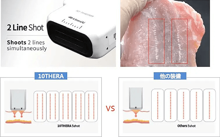 10THERA（テンセラ）ハイフの2Lineショット