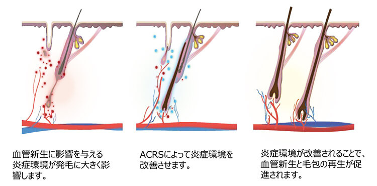 炎症免疫療法ACRSの発毛事例
