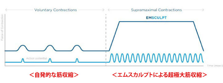 HIFEMによる超極大筋収縮