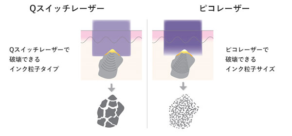 Qスイッチレーザーとピコレーザー