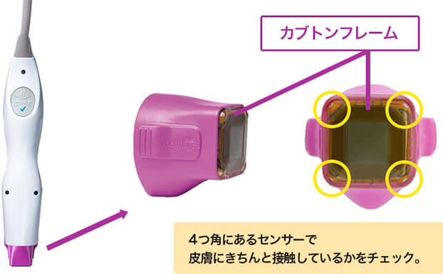 カプトンフレーム採用で治療効果が向上