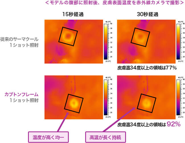 カプトンフレーム採用で治療効果が向上