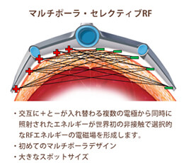 マルチポーラ・セレクティブRF