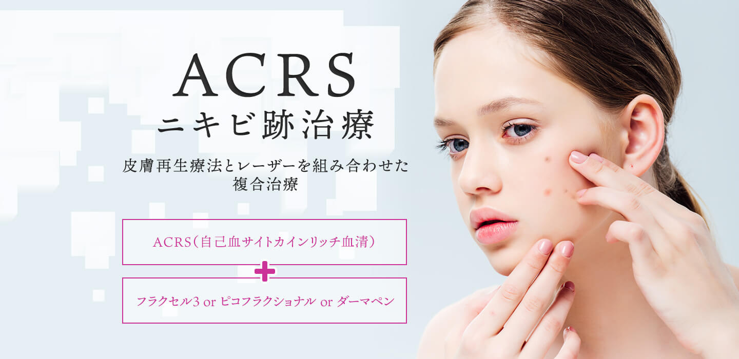 ACRS ニキビ跡改善治療