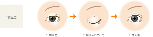 埋没法