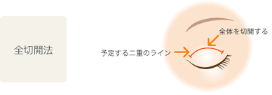 切開法
