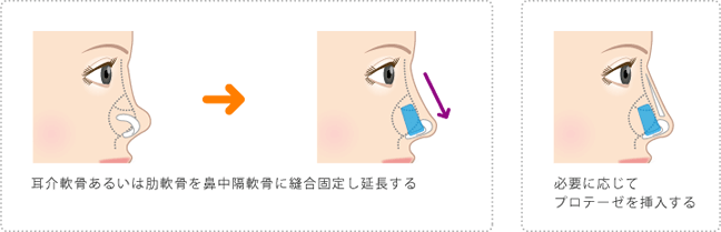 鼻中隔延長