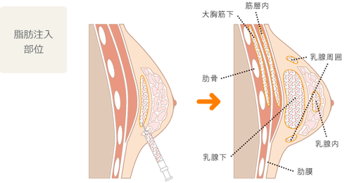 豊胸術（脂肪注入）
