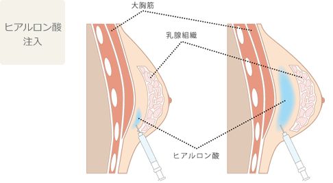 プチ豊胸術（ヒアルロン酸注入）