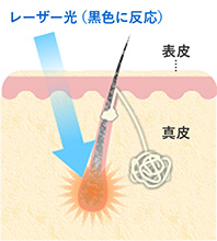 脱毛の原理