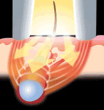 医療レーザー脱毛・E-LASER(光脱毛)の特徴